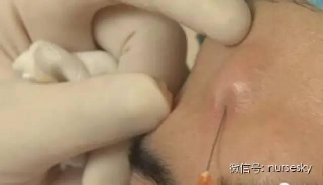 「护理知识」打针起硬结怎么护理？