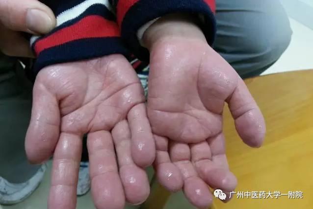 「支招」手汗滴答答，感觉是“怪咖”？十几分钟的微创手术，即可轻松解决！