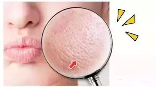 毛孔粗大究竟该怎么护理？