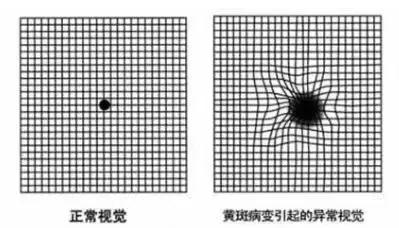 「科普」认识一下最凶险的眼病——黄斑病