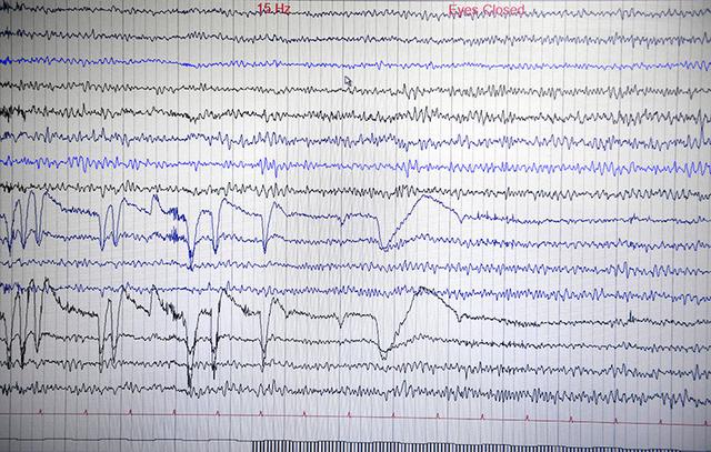 Nature：这种脑刺激试验有助消除抑郁症
