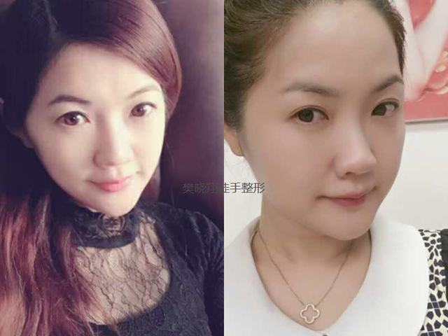 新加坡海归女高管亲述徒手鼻子整形，不用借助任何工具