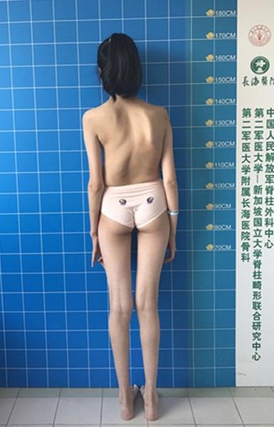 手术矫治马凡综合征合并重度脊柱侧弯 花季少女重新挺直脊梁