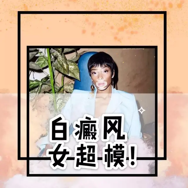 白癜风女超模，另类美Winnie Harlow