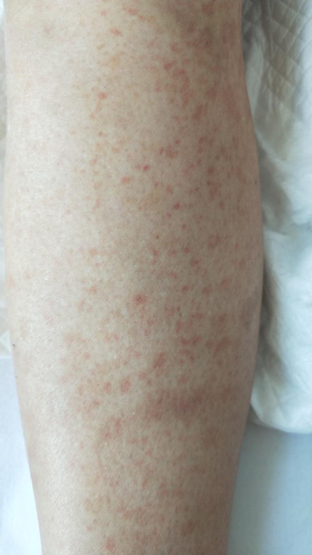 过敏性紫癜肾炎临床表现