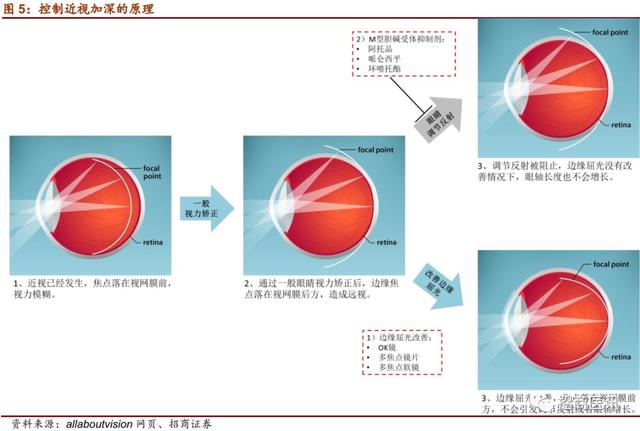 近视控制行业深度报告--近视防控势在必行，干预手段首推OK镜