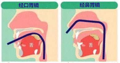 如何才能消除被胃镜支配的恐惧？