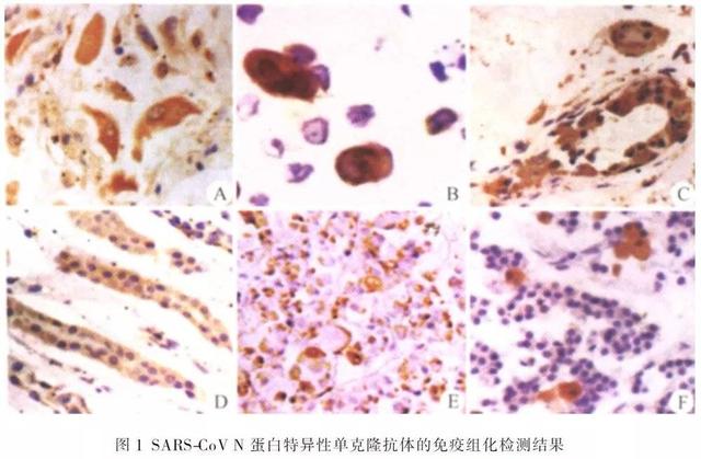 对肺炎逝者进行尸检，我们能知道些什么？