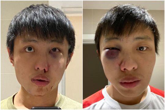 新加坡学生因新冠肺炎遭歧视：伦敦街头被暴打，左眼肿胀脸部骨折