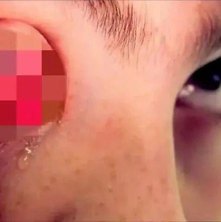 非洲两国暴发神秘传染病！患者口眼流血身亡，死亡率比鼠疫更高