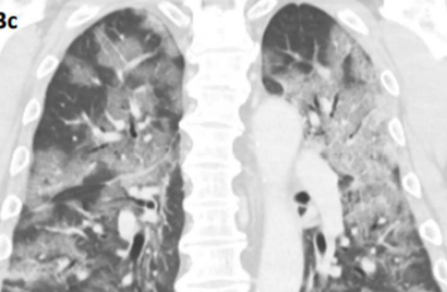 新加坡医疗报告首次公布扫描影像，新冠肺炎患者肺部出现“碎石路”阴影