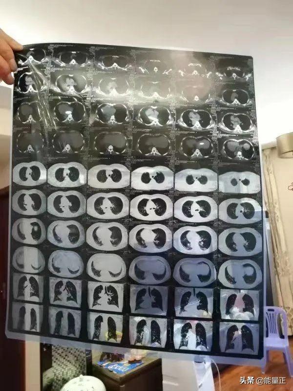 一个武汉中产家庭的抗疫史：一夜之间全家沦陷