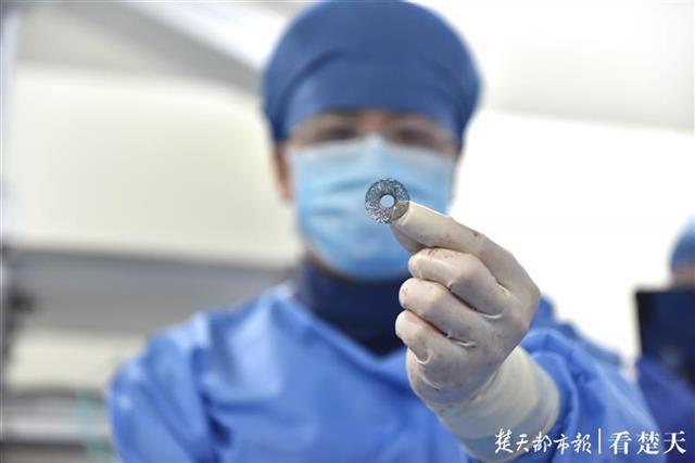 全国首创！68岁心衰太婆心脏膨大压扁了肺和胃，心房分流器植入术救回她一命