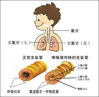 5.5​世界哮喘日：控制哮喘 珍爱生命