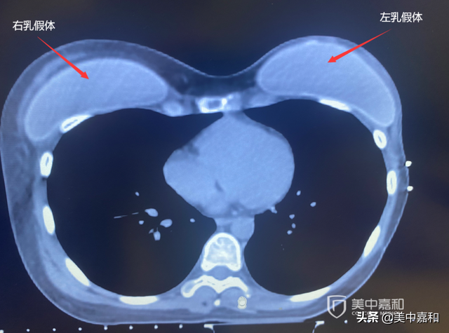 乳腺癌切除后隆胸，如何才能不复发？