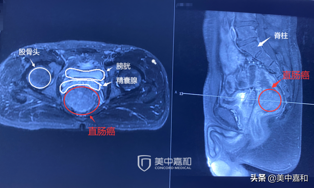 保肛又保命，只能二选一吗？