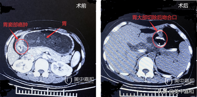 放化疗“有毒”？又要防复发，做还是不做？