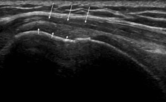 肩部超声检查须避免落入图像误判的陷阱