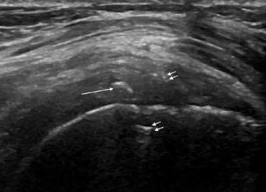 肩部超声检查须避免落入图像误判的陷阱