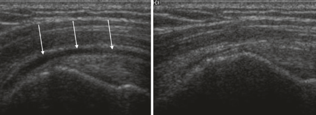 肩部超声检查须避免落入图像误判的陷阱