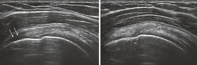 肩部超声检查须避免落入图像误判的陷阱