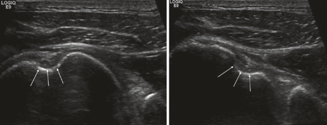 肩部超声检查须避免落入图像误判的陷阱