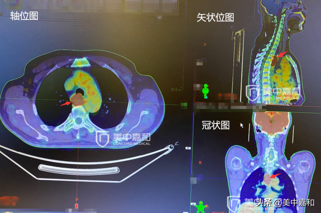 防止癌症术后复发，这些方法你试过没？