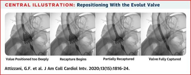 JACC专刊，关注TAVR热点：二叶瓣畸形、左室流出道钙化、瓣膜回收……｜安贞心语