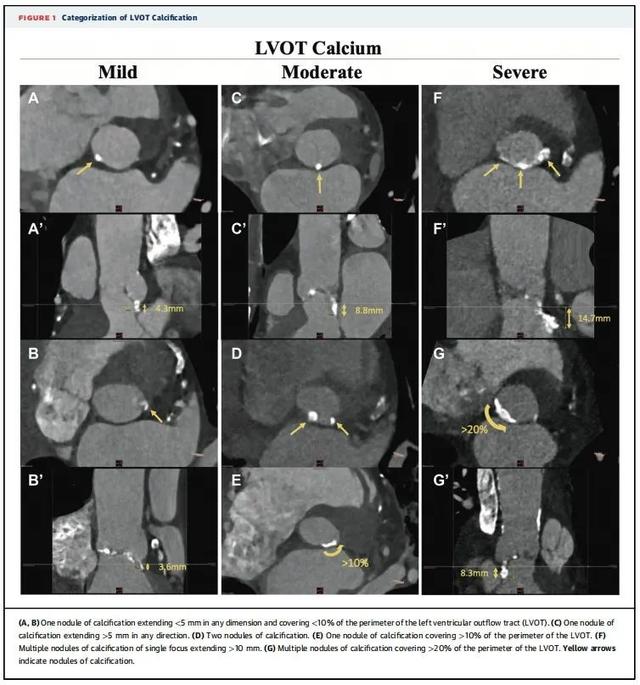 JACC专刊，关注TAVR热点：二叶瓣畸形、左室流出道钙化、瓣膜回收……｜安贞心语