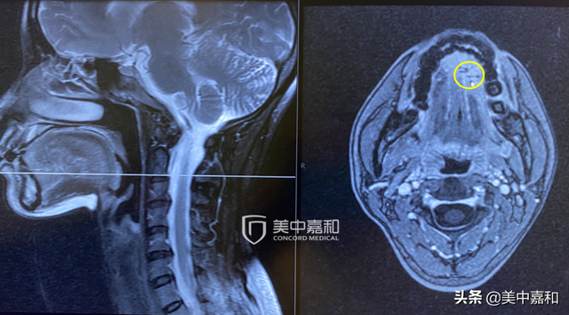 这种“罕见癌”，如何防术后复发？