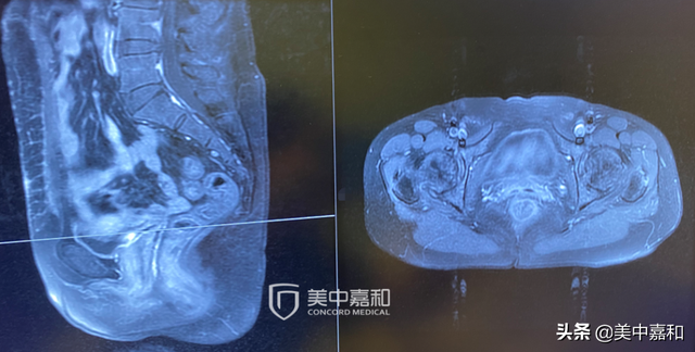 手术成功就能“乘风破浪”？如何防止癌症复发？