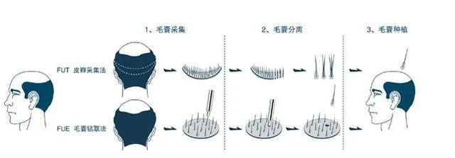 植发太贵，雷军吐槽“每个人头顶着一栋别墅”，植发经济了解下？