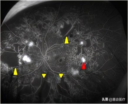 每只眼睛都是一个美丽星球，这些致盲性伤害，医生带你远离