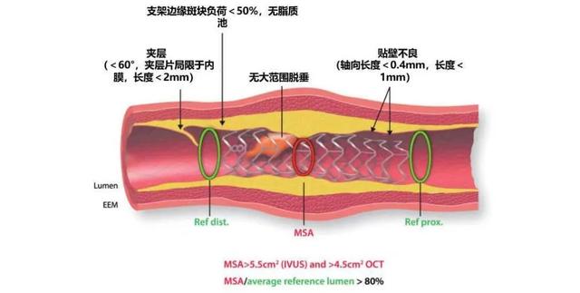 2018-2020年腔内影像学及生理学：最新循证证据汇总｜安贞心语