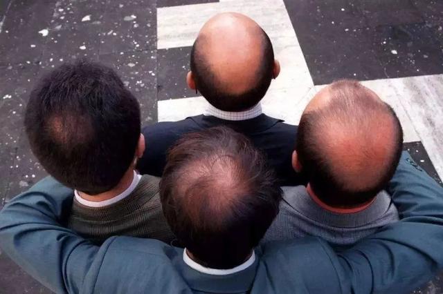男性秃顶与新冠感染风险有关？程序员们要注意了