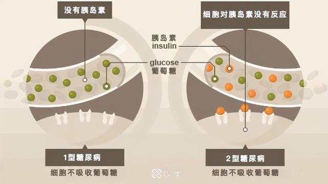 为何亚洲人容易得糖尿病？避免糖尿病并发症，干细胞来帮忙