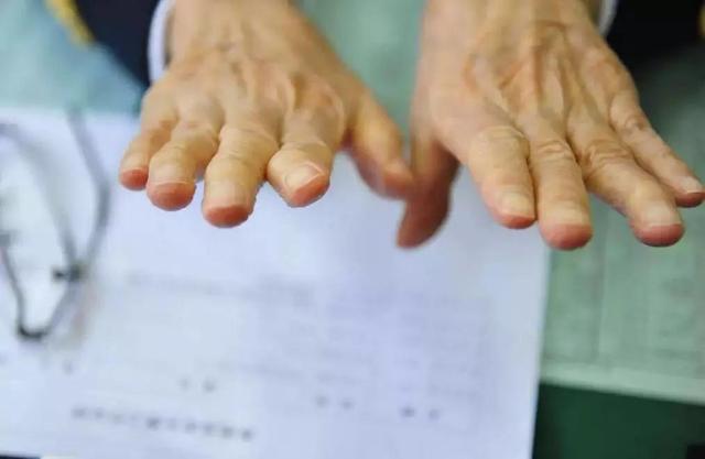 吴孟超变形的手指，扳正了我们对医生的误解：医者佛心