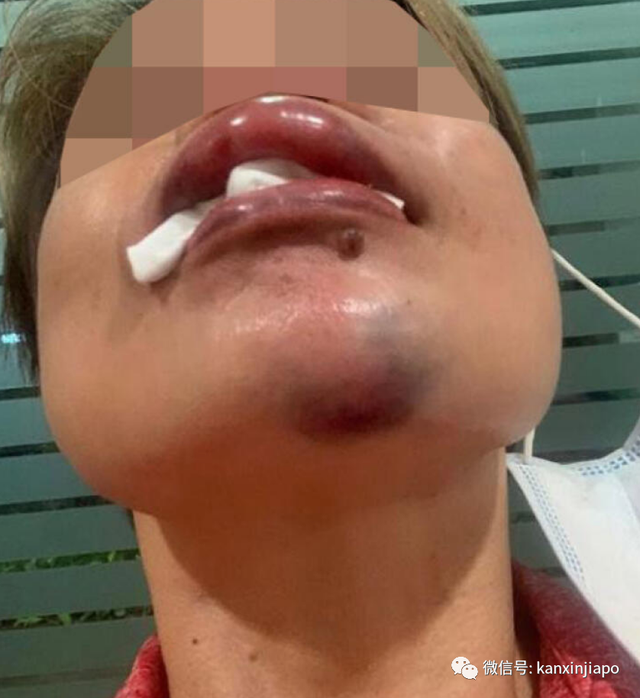 因为拍摄不戴口罩聚赌，新加坡女经理被揍到脸颊骨折