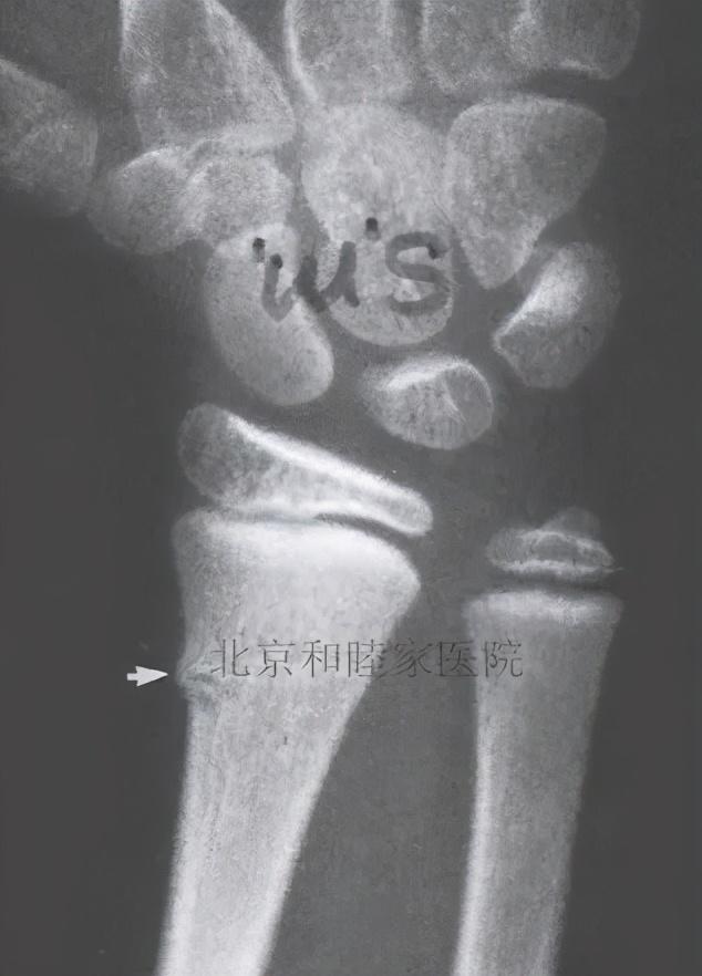 孩子骨折了第一时间该怎么做？骨科专家这么说