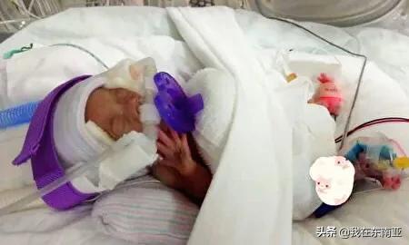 世界最轻新生儿仅一苹果重 住院13月后回家