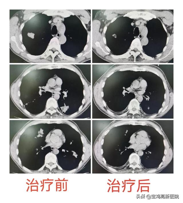 全省首例 | 宝高医确诊一例“嗜酸性肉芽肿多血管炎（EGPA）合并变应性支气管肺曲霉菌病（ABPA）”病例