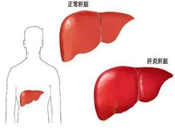 刘渡舟治疗病毒性肝炎用柴胡三石解毒汤