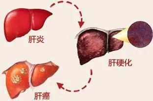 刘渡舟治疗病毒性肝炎用柴胡三石解毒汤