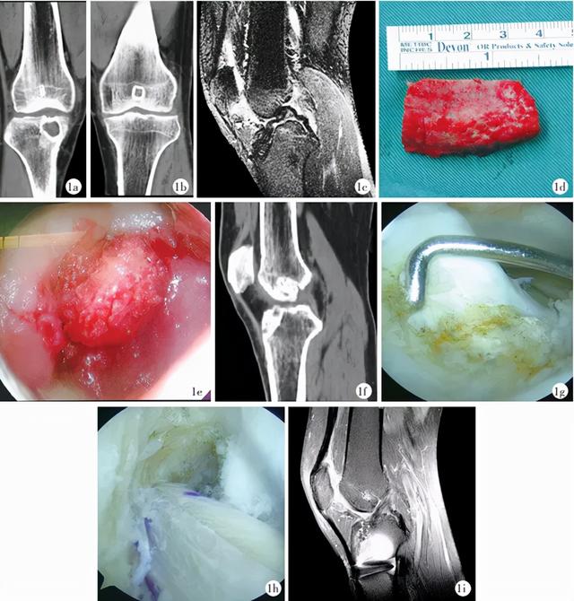 临床技术 | 分期植骨翻修重建治疗前交叉韧带重建失败伴骨隧道扩大