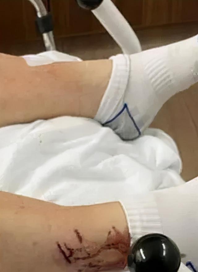 新加坡男子晨跑竟被水獭群围攻，10秒内被咬26次，医药费6000元