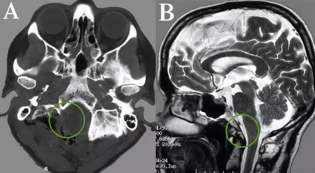 走路乏力、脖子痛，被“颈椎病”耽误的枕骨大孔脑膜瘤怎么办？