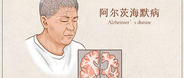 日本开发的老年痴呆症预防药，下个月开始临床试验