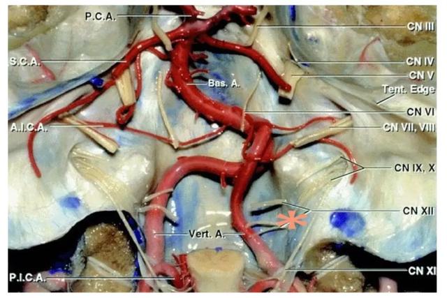 走路乏力、脖子痛，被“颈椎病”耽误的枕骨大孔脑膜瘤怎么办？