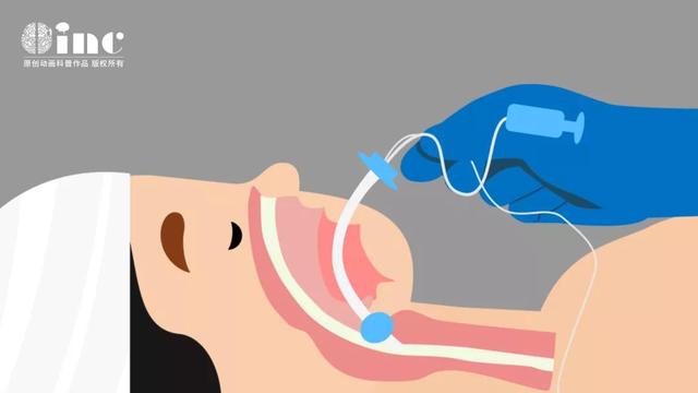 走路乏力、脖子痛，被“颈椎病”耽误的枕骨大孔脑膜瘤怎么办？