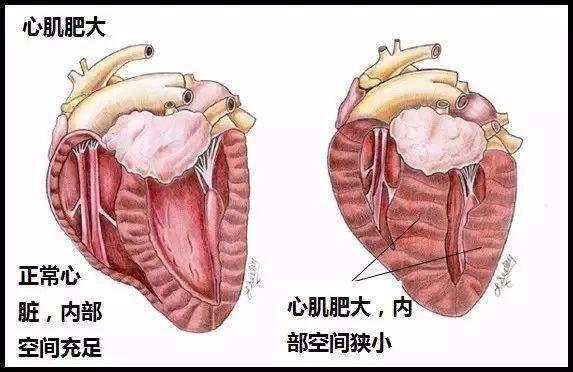 联拓生物宣布Mavacamten在中国获得“突破性治疗药物”认证